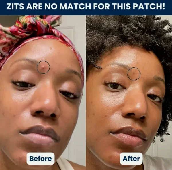 Vegan Pimple Dots - Zit Care Sticker